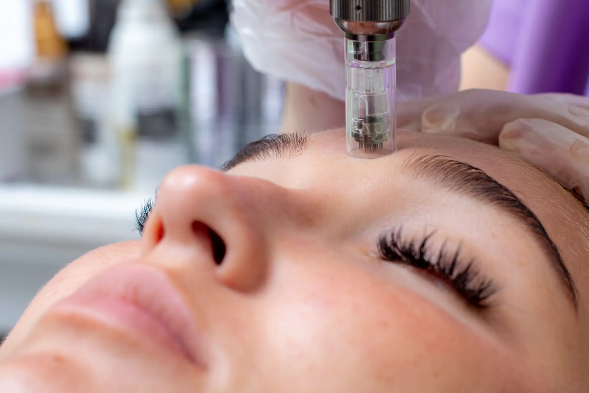 Microneedling in Ashburn, VA at Glamify Medspa