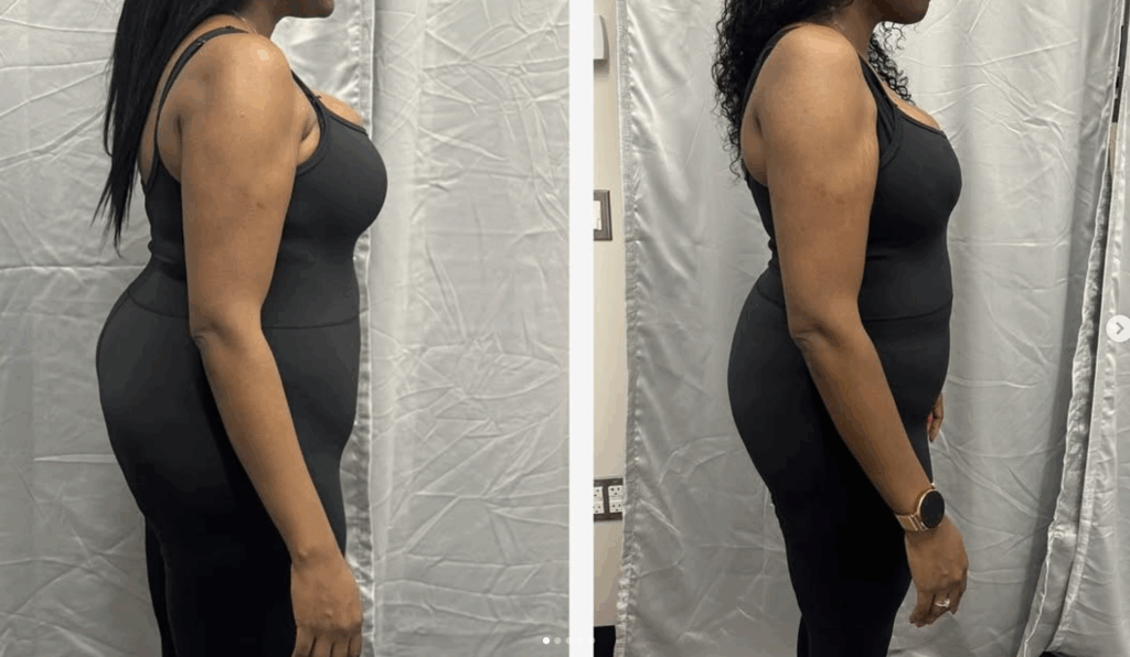 Before and after medical weight loss results showing visible body transformation